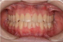 叢生（歯並びが凸凹、乱杭歯）の画像１