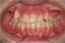 上顎犬歯の低位唇側転位（八重歯）の画像１