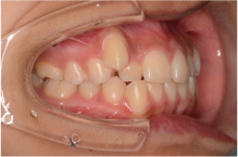 上顎犬歯の低位唇側転位（八重歯）の画像２