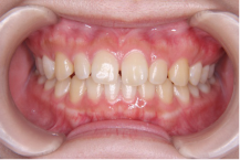 空隙歯列（すきっ歯）の画像１