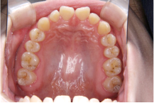 空隙歯列（すきっ歯）の画像２