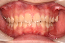 上顎前突（出っ歯）の画像１