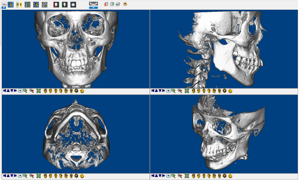 初回カウンセリング　3Dデジタル矯正の画像