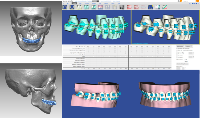 3Dデジタル矯正（デジタル矯正システム）の様々な画像