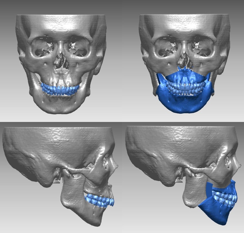 外科矯正の3Dデジタル矯正の画像