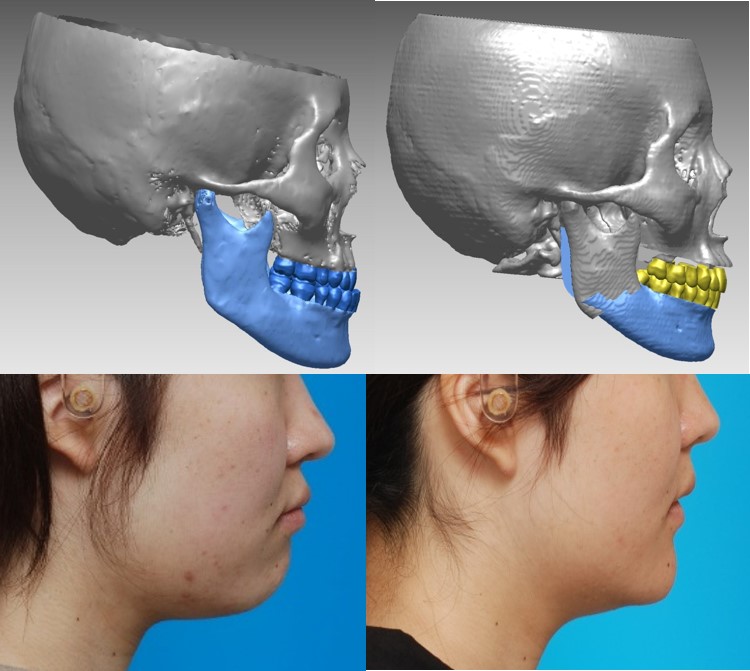 外科矯正の3Dデジタル画像と実際の横顔の画像