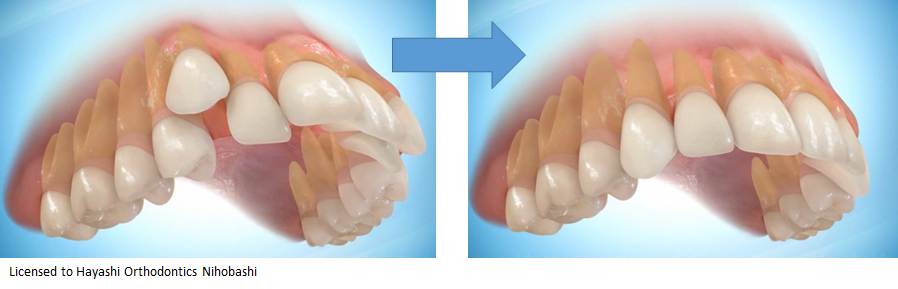 歯列矯正の画像