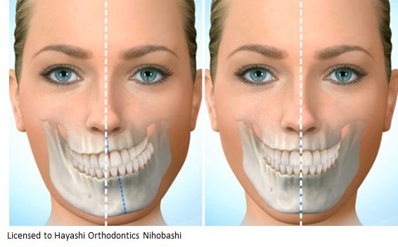 顎の骨が曲がっている人の治療前と治療後の画像