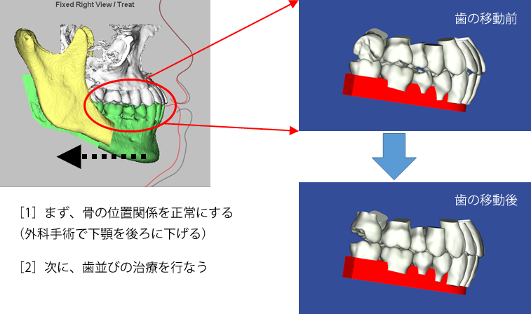 サージェリーファーストの歯の移動前後のシミュレーション画像