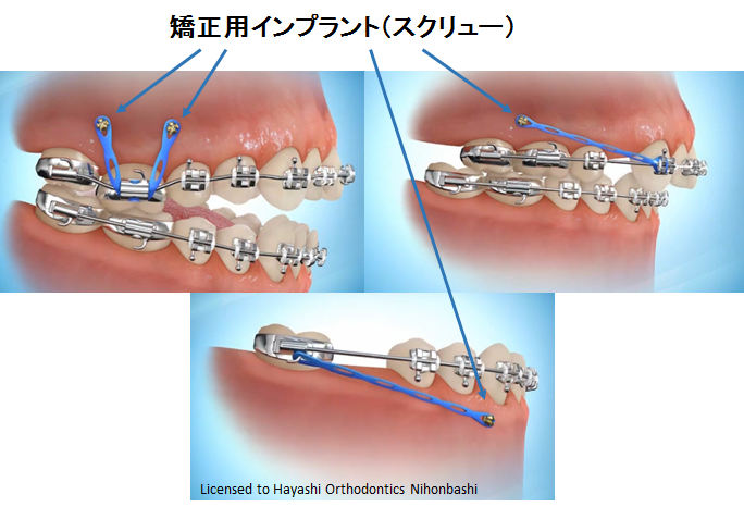 インプラント矯正 - 【公式】日本橋はやし矯正歯科