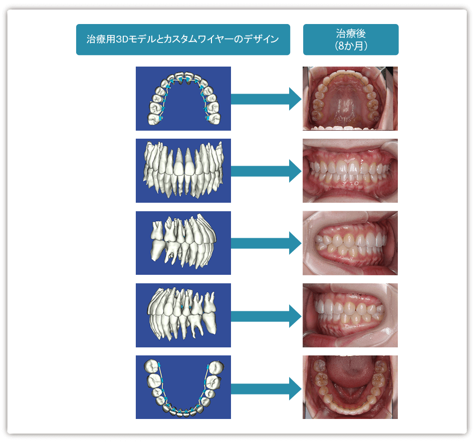 症例11：空隙歯列矯正の説明画像