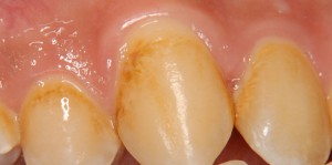 ステイン除去前の歯の写真