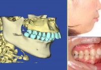 矯正治療の歯根吸収問題の写真