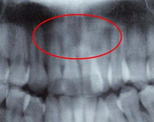 歯根吸収前の初診時の写真