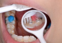 矯正中の歯磨き、デンタルミラーを使う