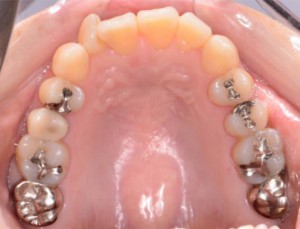 歯の凹凸、叢生の患者様の写真