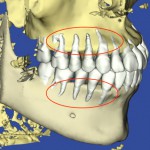 歯の凹凸、叢生の患者様の3Dシミュレーション最初の状態