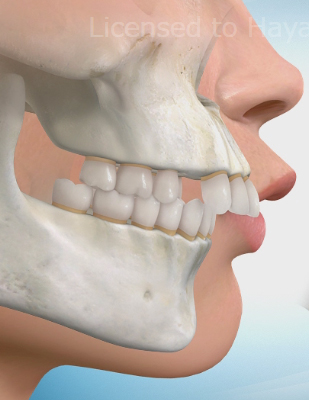 出っ歯の矯正治療について