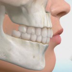 出っ歯の矯正治療について