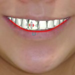 スマイルラインと矯正歯科治療　歯の位置の整え