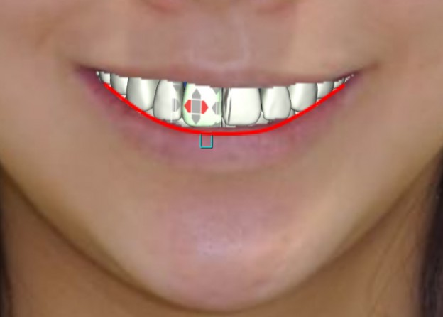 スマイルラインと矯正歯科治療　歯の位置の整え