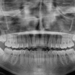 親知らずを抜歯しました　矯正歯科医院スタッフのブログ