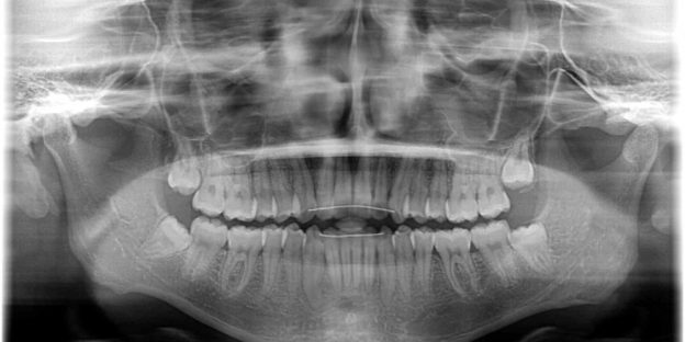 親知らずを抜歯しました　矯正歯科医院スタッフのブログ