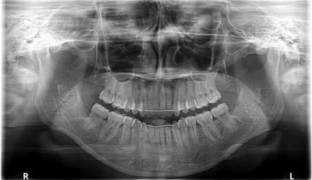 親知らず抜歯後のレントゲン写真
