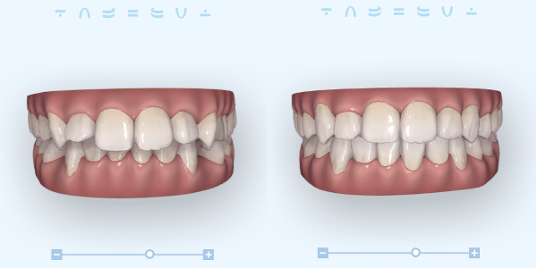 左がインビザライン治療開始時、右が治療終時のクリンチェック（シミュレーション）の画像