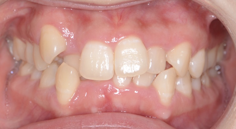 カスタム・コンビネーション矯正治療前の口腔内前からの画像