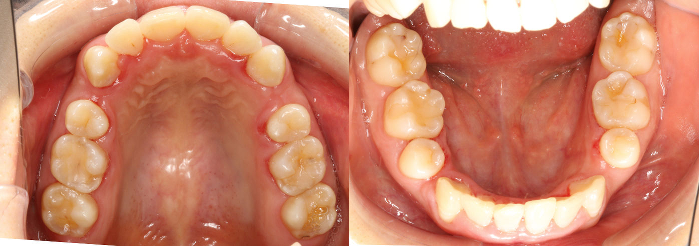 マウスピース型矯正装置を使用する前の上顎と下顎の画像