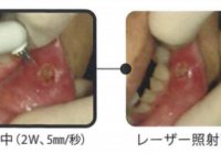 レーザー治療器での口内炎の治療