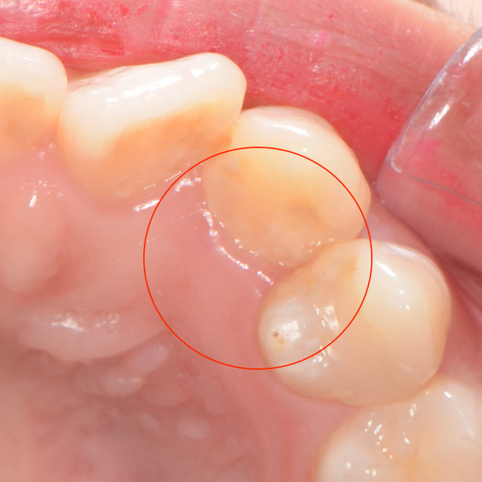装置装着前の上顎の前歯、歯肉が盛り上がっていて装置をつけられない画像