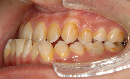 前歯の反対咬合、下顎骨の前突がある男性の術前の正面写真