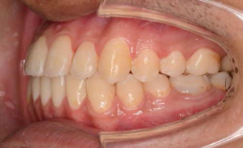 前歯の反対咬合、下顎骨の前突が改善された男性の術後の正面写真