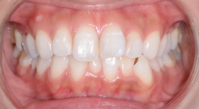 上下前歯の凸凹（叢生）の術前正面の画像
