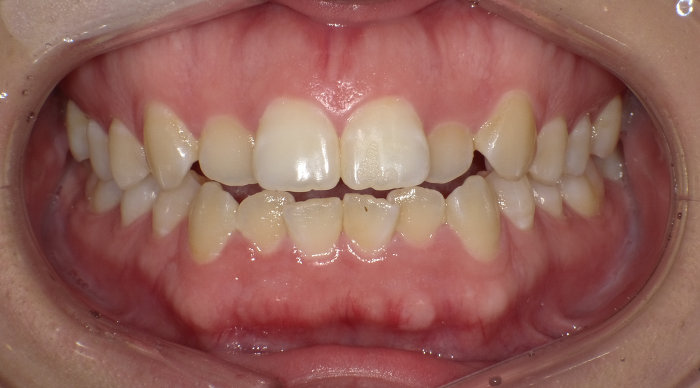 上下前歯の凸凹（叢生）と開咬の術前の画像