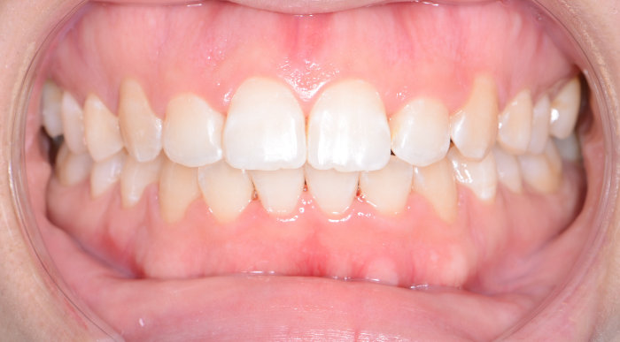 上下前歯の凸凹（叢生）と開咬の治療期間半年の術後の画像