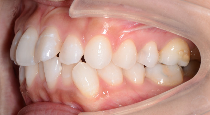 上下前歯の凸凹（叢生）の術前横からの画像