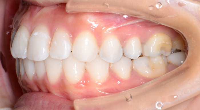 上下前歯の凸凹（叢生）の6ヶ月治療期間後の術後横からの画像