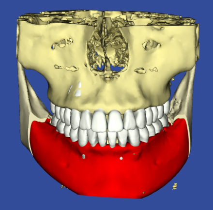 3Dデジタル矯正による術後の予測シミュレーション画像