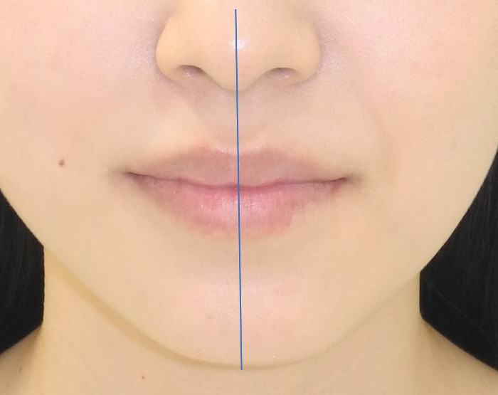 サージェリーファーストの治療後、顔面非対称が改善して左右対象になった画像