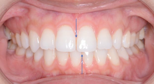 サージェリーファースト 顎の歪み 顔面非対称 の治療例 公式 日本橋はやし矯正歯科