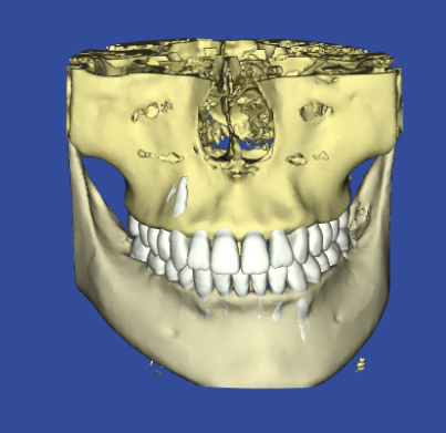 左右のお顔が非対称の3Dデジタル矯正によるシミュレーションの正面の写真