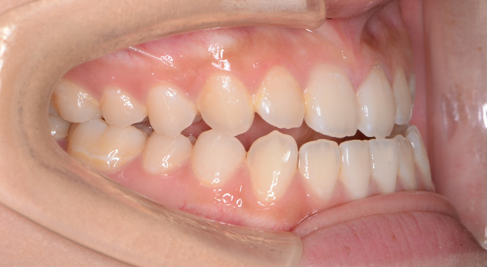 重度の開咬と下顎前突により反対咬合になっている治療前の画像