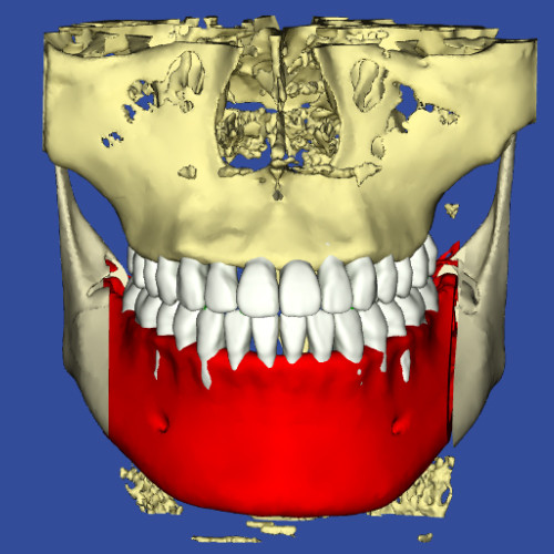 3Dデジタル矯正のシミュレーションの正面の画像