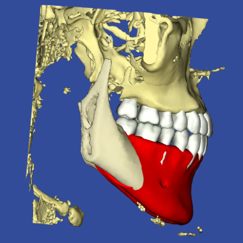 3Dデジタル矯正のシミュレーションの横顔の画像