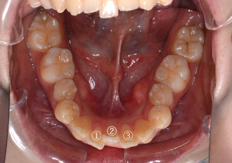 スリー・インサイザーの患者さまの下顎の写真