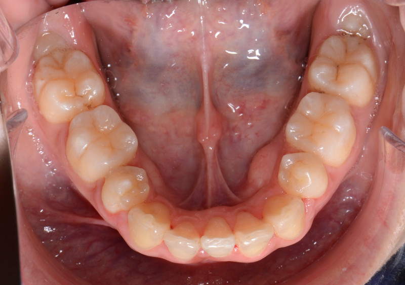 スリー・インサイザーの患者さまの治療後の下顎の写真