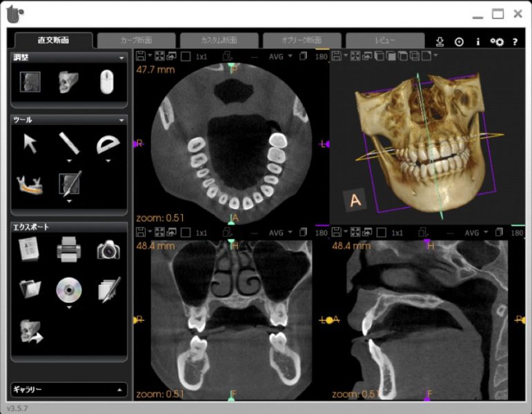 3Dデジタル矯正の頭部スキャンのCT画像